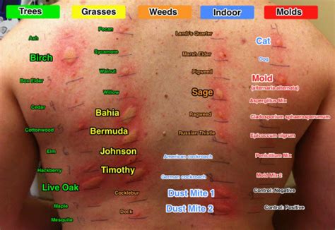skin allergy test philippines cost